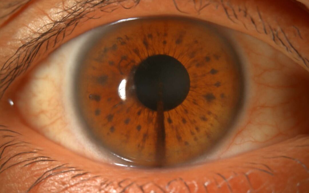 pigment dispersion syndrome: Unraveling the mystery of pigment shedding in the eye