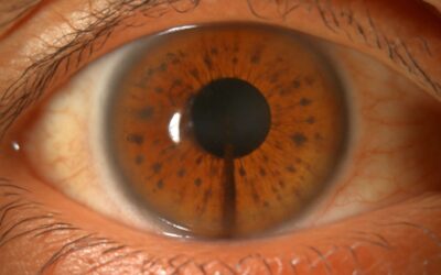 pigment dispersion syndrome: Unraveling the mystery of pigment shedding in the eye