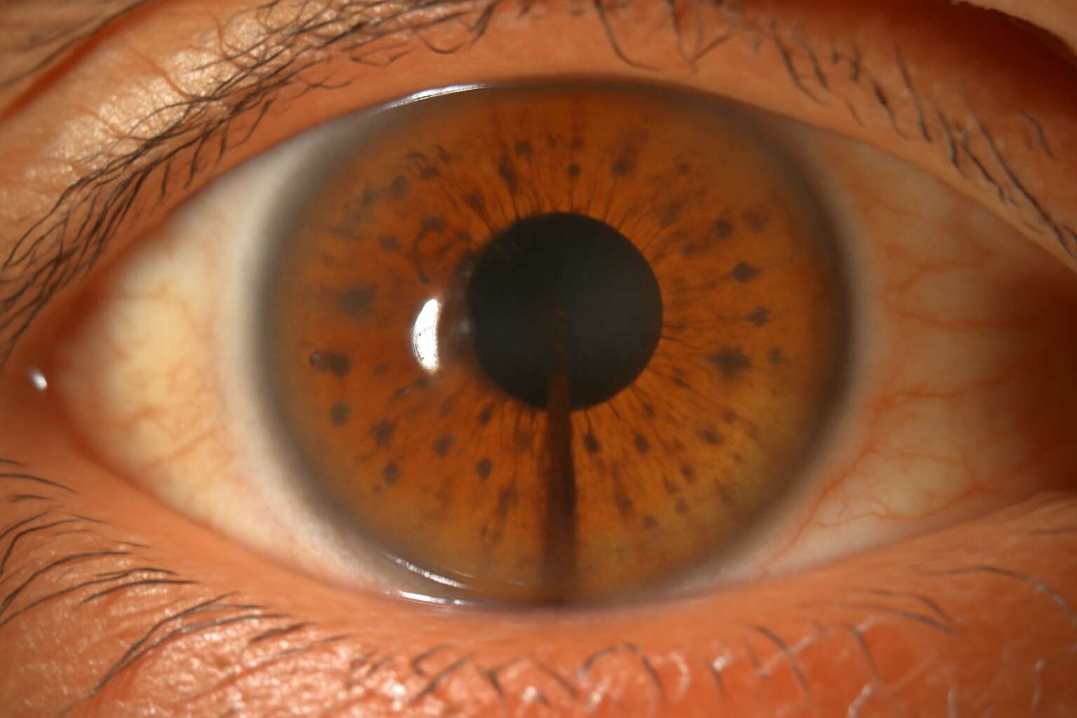 pigment dispersion syndrome