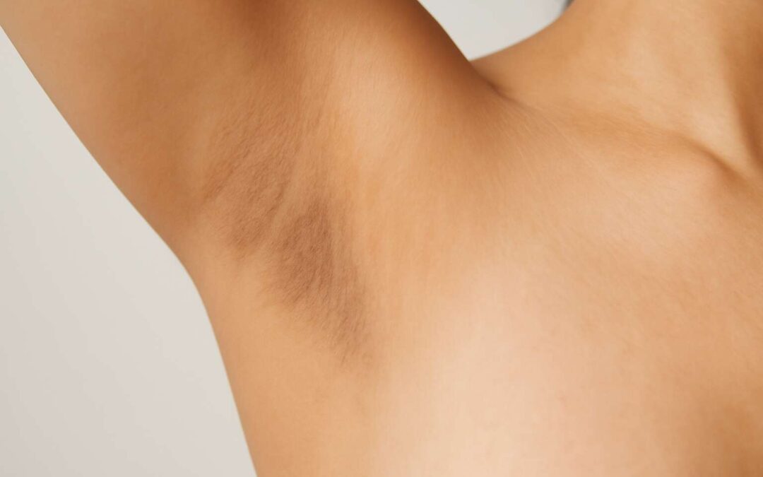 pigment under arm: unlock causes, treatments, and prevention tips.