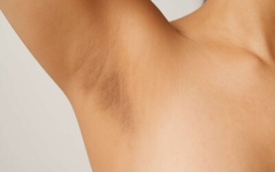 pigment under arm: unlock causes, treatments, and prevention tips.