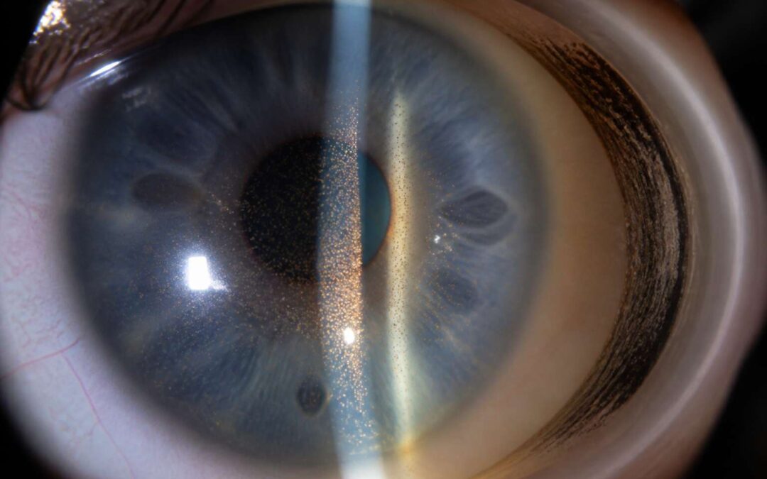Spot pigment glaucoma early to protect your vision.