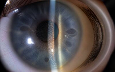 Spot pigment glaucoma early to protect your vision.