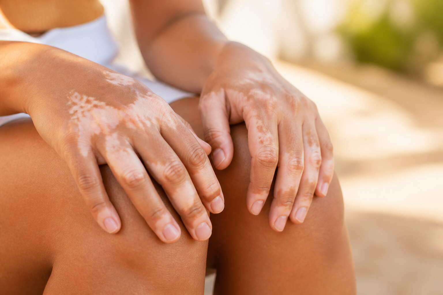 when pigment is loss in patches from the skin