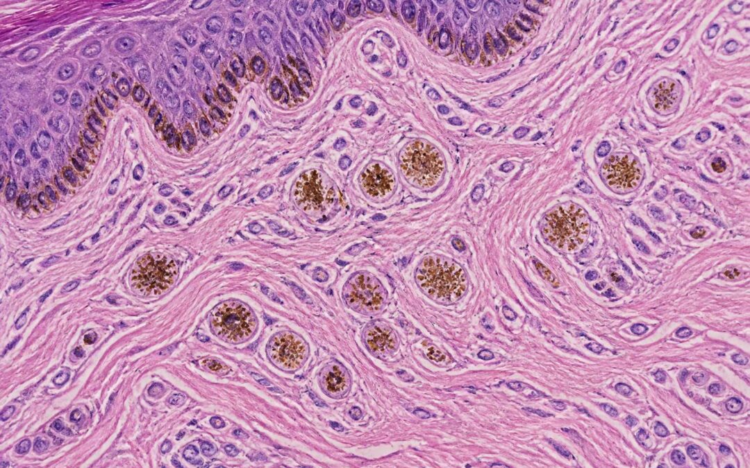 Pigment Incontinence: Causes, Symptoms, and Treatment Options.