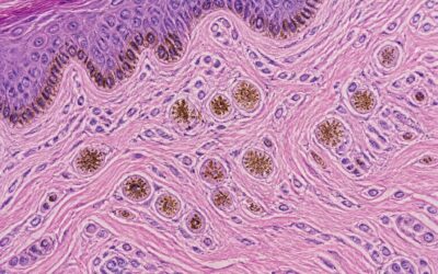 Pigment Incontinence: Causes, Symptoms, and Treatment Options.
